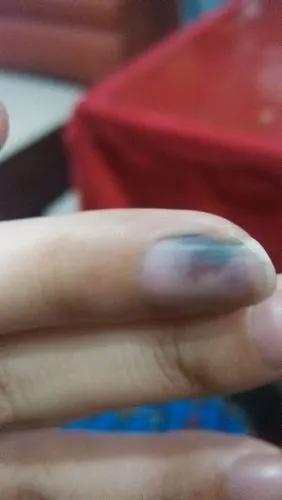 手指昨天被门夹了今天部分变紫了怎么办
