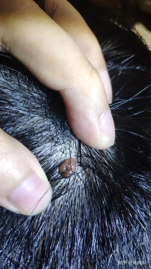 头皮上长了一个红色的小肉球不疼不痒的问一下是啥? - 知乎