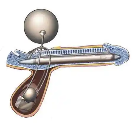 哪些男性可以做"阴茎假体植入"?