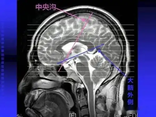 头颅mri读片知识人人入门必修内容