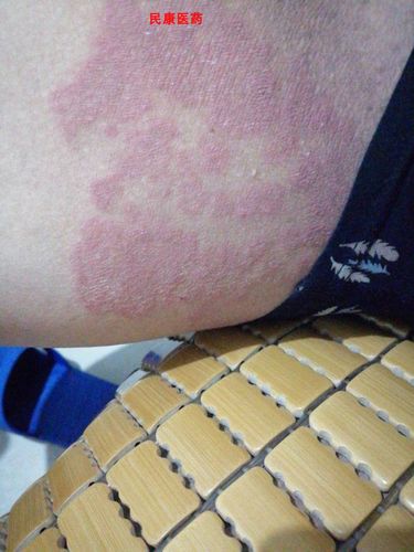 牛皮癣铍养宁舒肤王药膏软膏实体湿疹止痒去根药膏湿痒大腿内侧瘙