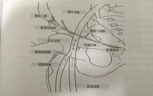 股动脉假性动脉瘤!