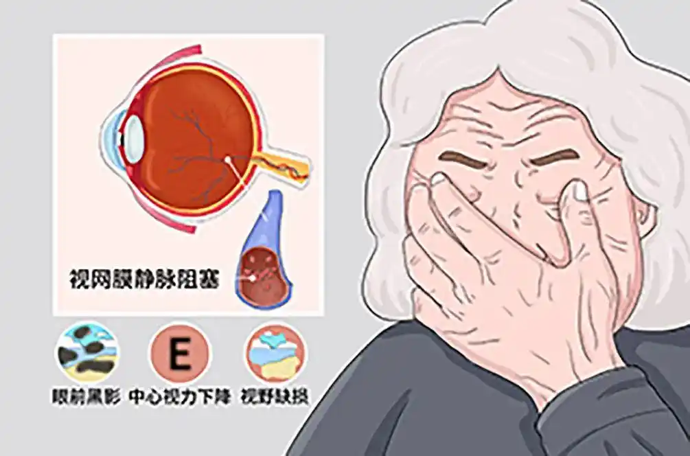 冬季眼中风高发耽搁90分钟永久失明