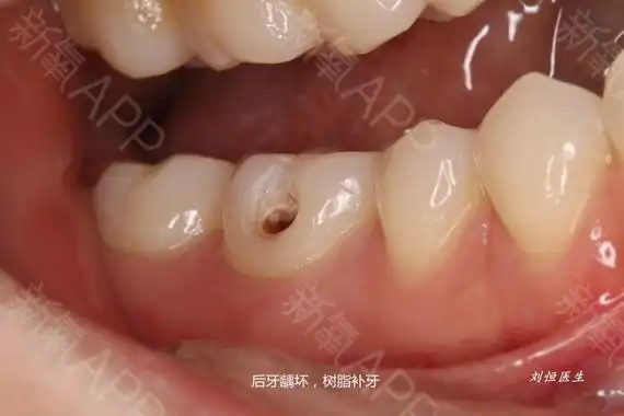 案例分享# 后牙6颊侧龋坏,去腐备洞,用树脂进行修复.