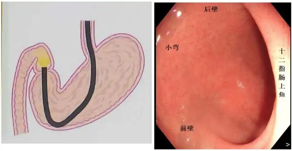 胃镜操作如何避免漏诊内镜医生总结10大观察要点干货教程