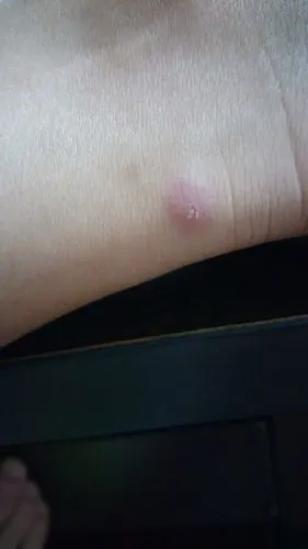 外出旅行回来后,脚踝长了许多类似蚊子咬的包一样的肿块,顶端有_皮肤