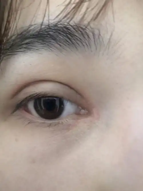 开眼角20天有白色疤印,怎么护理?