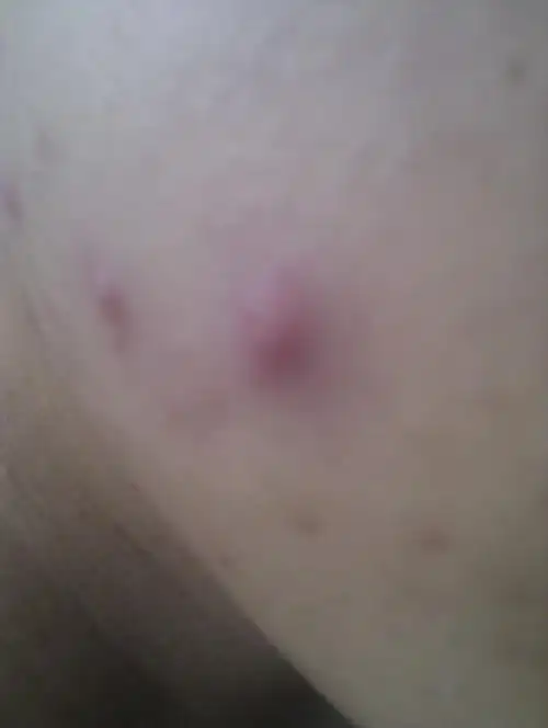 最近脸上出了一些红色痘痘 捏着里边有肿块 硬硬的 过段时间会有脓水