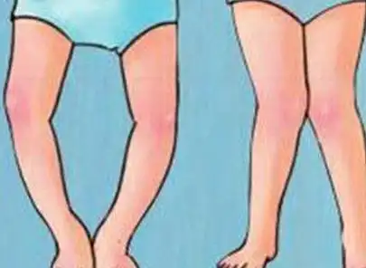 如果患者是儿童或者青少年,轻度的o型腿矫正是可以矫正的.