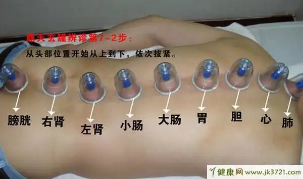 拔罐后皮肤颜色怎么鉴别病情?