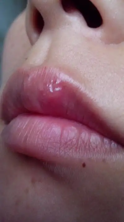 嘴唇疱疹感染图片 (10)_有来医生