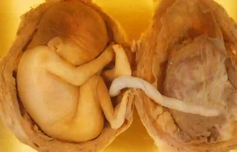 高龄试管双绒双羊需要做减胎手术吗