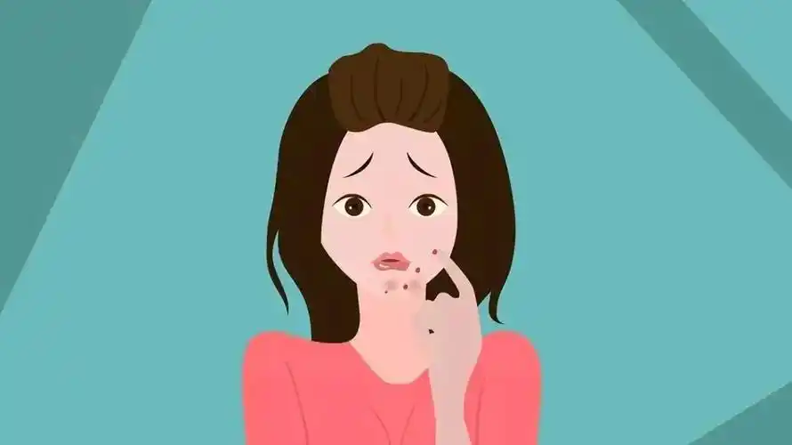 谁能理解一脸痘痘的无奈在这个"看脸"的时代"烂脸"到底什么时候是个头