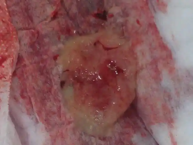 请问我药流第三天就流出这个东西,这是设么?