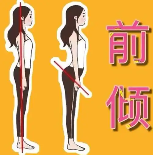 肚子很大骨盆前倾是怎么造成的骨盆前倾如何矫正