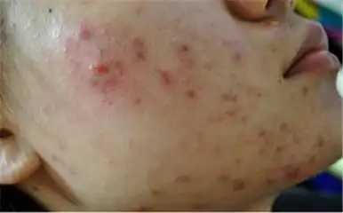 丘疹性痤疮