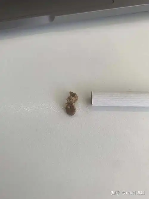 我尿出了13cm的石头