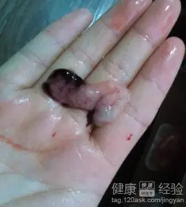 42天药流排出孕囊图片 - 搜狗图片搜索