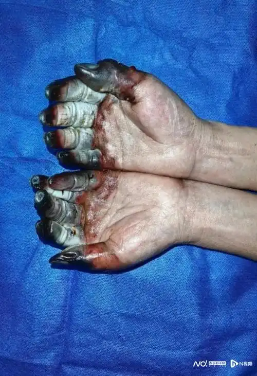 医生:冻伤别大意,严重要截肢