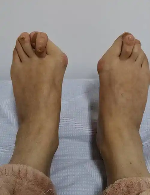 拇外翻越发严重了怎么办?大脚骨严重怎么手术