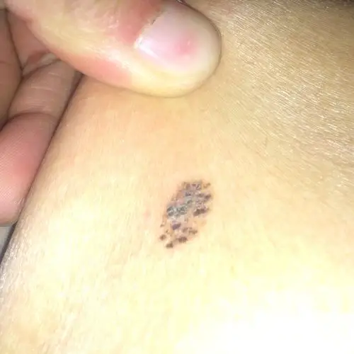 这个痣危险么里面都是小黑点