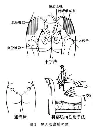 肌肉注射具体部位