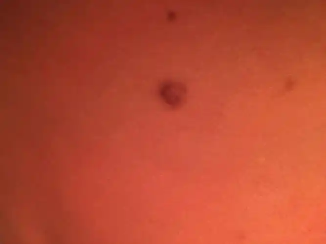 皮肤上出现了很多凹陷的圆圈,中间的肌肉萎缩了.