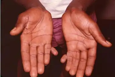 如果您一出生就六指,这意味着什么?