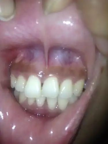 请问图片中我的牙龈萎缩的厉害吗!