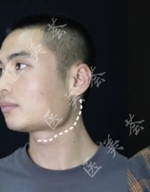 下颌角突出图片