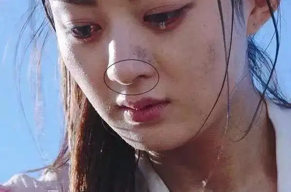 赵丽颖毛孔吸盘来了10年粗大黑头一挤就滑出拒绝草莓鼻