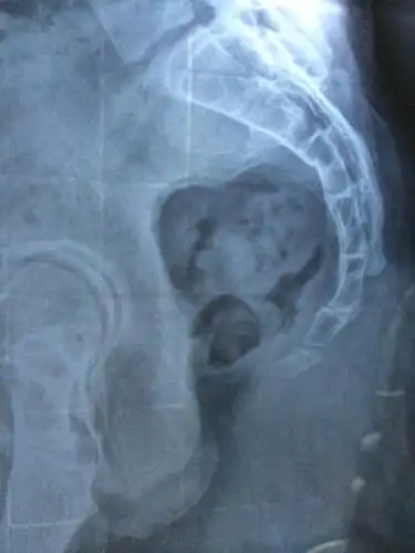 尾椎骨受伤,这是拍的x片,请帮忙看下严不严重?