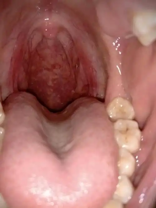 嗓子上有疙瘩,老是反复复发,又快2年了,怎么回事?