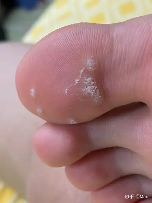 水泡里面有黑色的刺白天不怎么明显,到了晚上的时候,泡了脚,就很明显