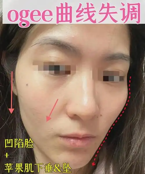 先声明,我是高颧骨类型,所以我属于ogee过凹的内缩型你看我22年的时候