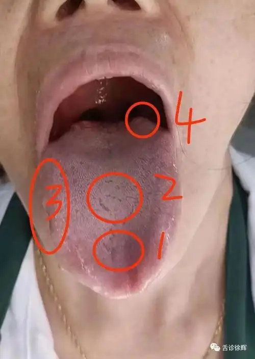 胃痛胃胀,睡眠质量差消瘦有一年时间,白天没精神,嗜睡,慢性萎缩性胃炎