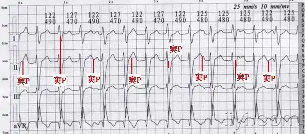 宽qrs心动过速伴房室分离心电图.jpg