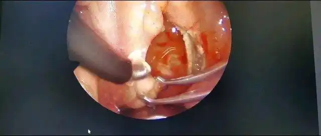 低温等离子扁桃体切除术,可以做到一气呵成,泾渭分明,滴血不出!