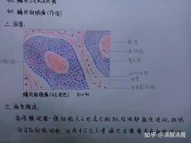 ⑦鳞状细胞癌⑥结核肉芽肿⑤五种炎细胞④混合血栓③慢性肺淤血②肉芽