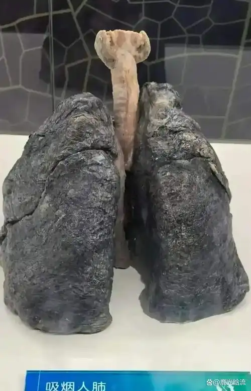 确切地讲,这是一位抽了几十年烟的烟民的肺.为何会黑成这般模样?