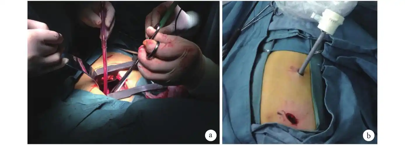 小切口开胸与电视胸腔镜下儿童肺叶切除短期效果的病例对照研究