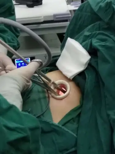 滨州市第二人民医院胸外科成功完成单孔胸腔镜肺叶肺段切除手术