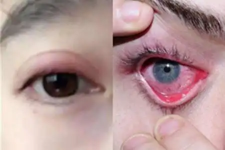 眼睛发炎怎么治疗呢如何护理眼部疾病