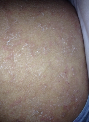 银屑病早期图片 (57)