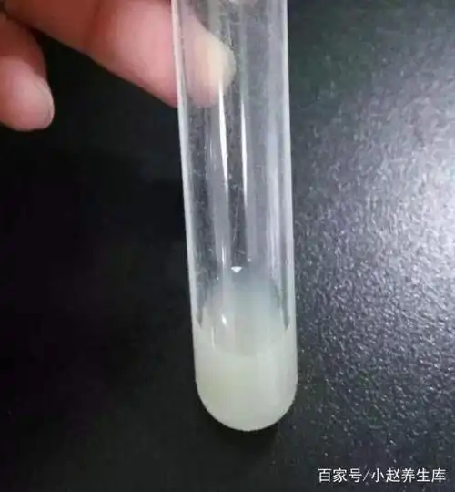 乳白色的尿在医学上称为丝虫病,就是血丝虫感染,导致我们的淋巴血管