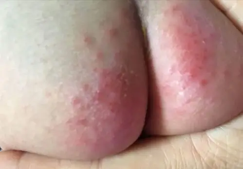 这样给宝宝使用尿不湿,容易造成宝宝泌尿系统感染,高烧不退