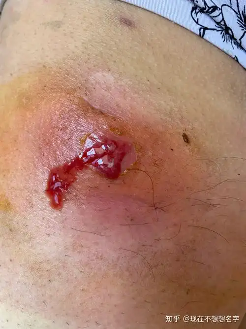 自己处理两次不同的火疖子