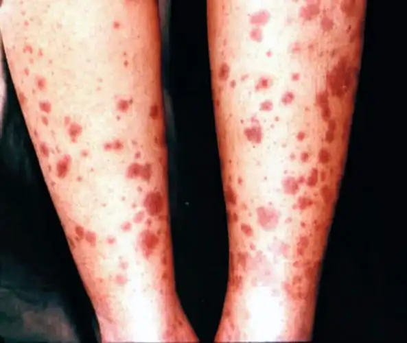 系统性红斑狼疮全身皮疹症状图_有来医生