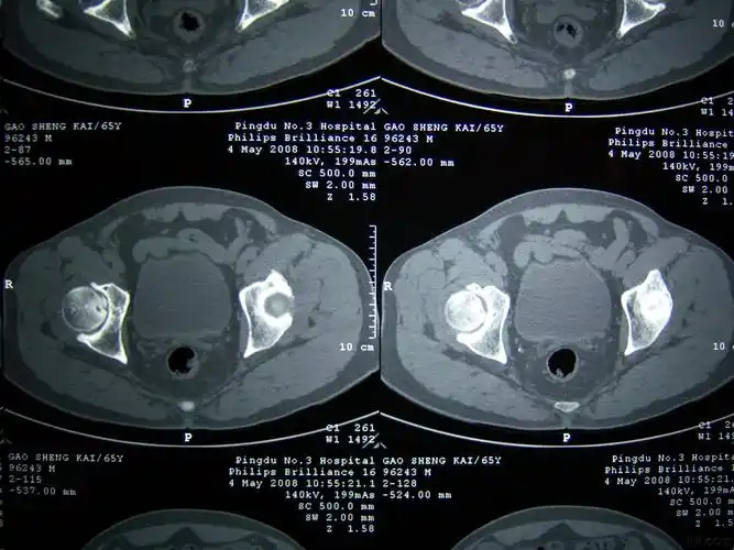 骨盆ct片高手阅片啊