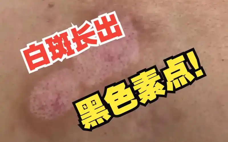 小伙才治了6次白癜风,背部白斑就已长出黑色素点,效果太好了!